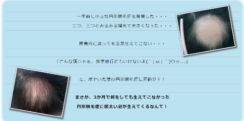 家庭でできる円形脱毛症回復プログラム.png